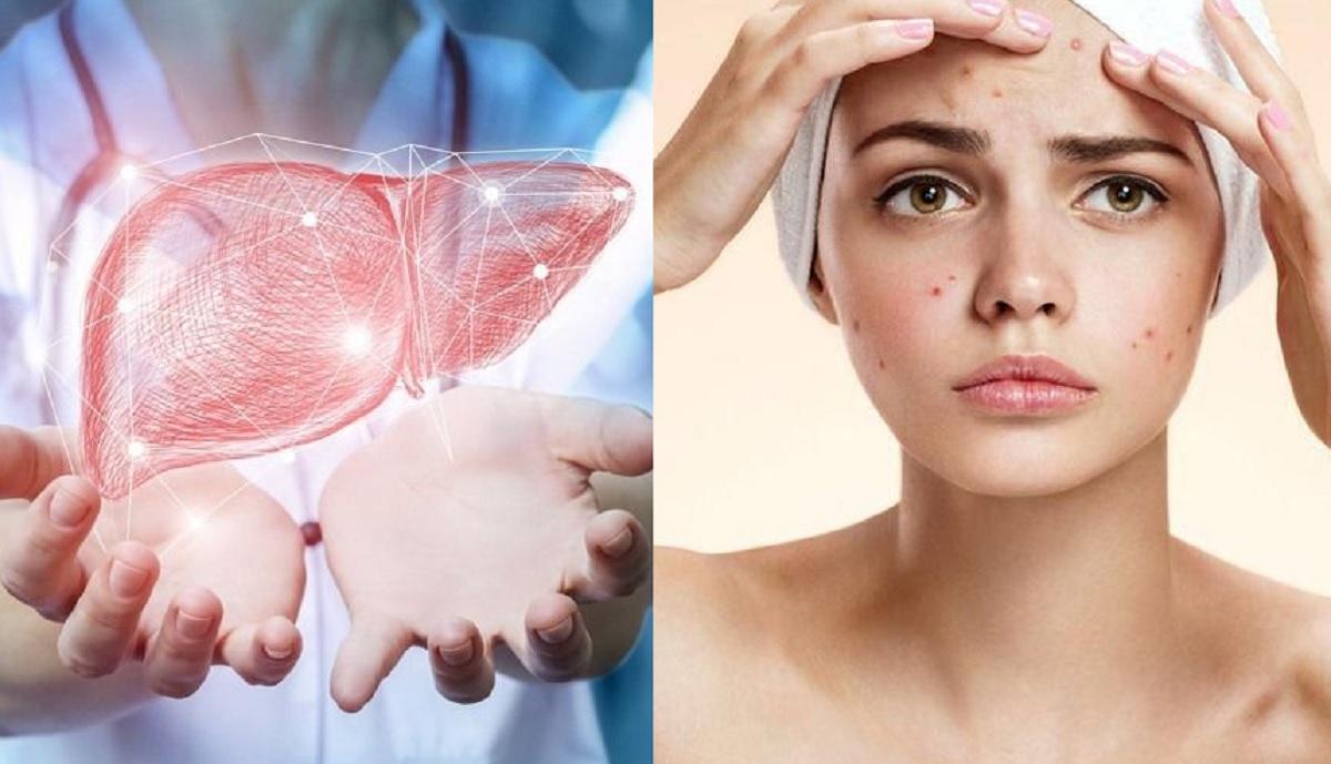 Da xỉn màu, nổi mụn không rõ nguyên nhân – Có phải do gan?