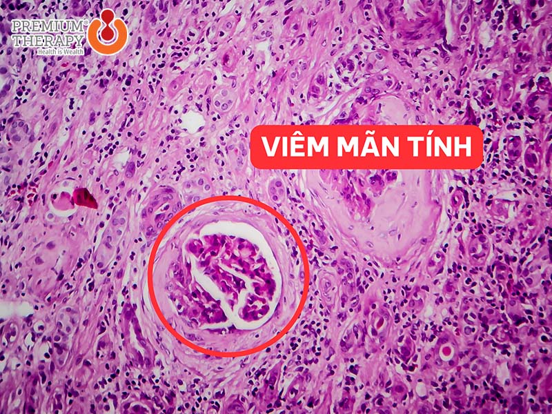 Viêm mạn tính – Cơ chế âm thầm phía sau nhiều bệnh lý hiện đại